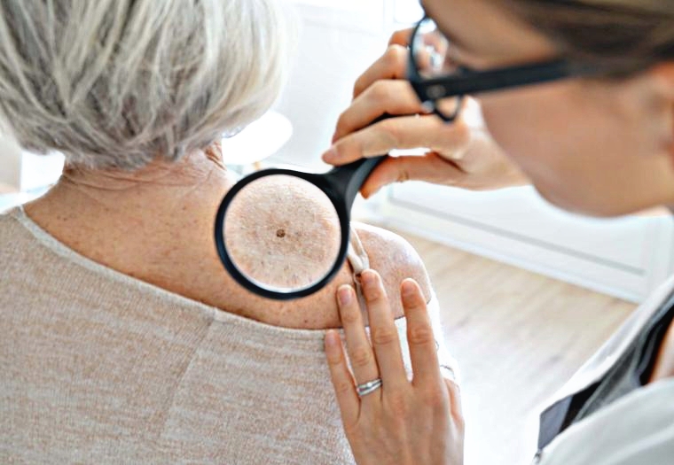 Revisión de lunares para detección temprana de melanoma