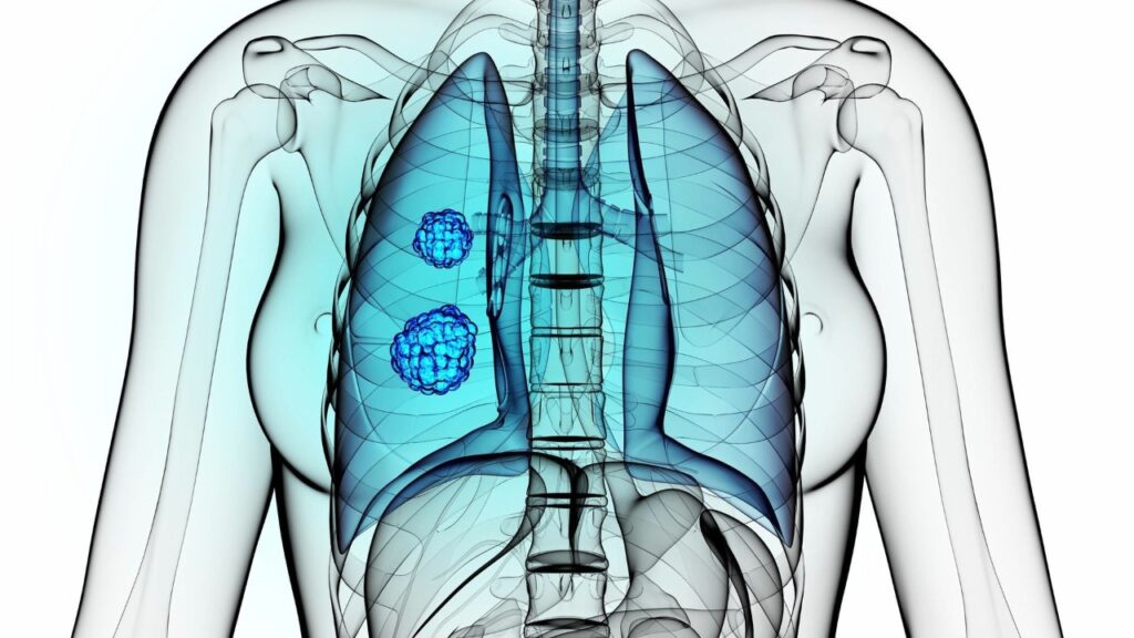 Cáncer de pulmón, diagnóstico y tratamiento quirúrgico