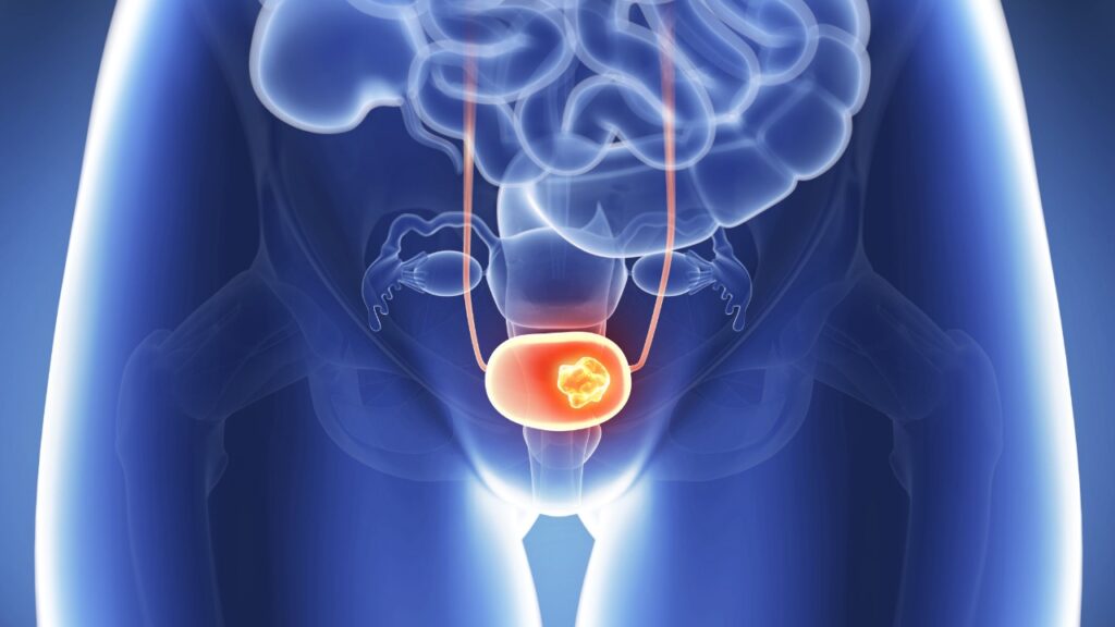 Cáncer de vejiga, diagnóstico y tratamiento quirúrgico