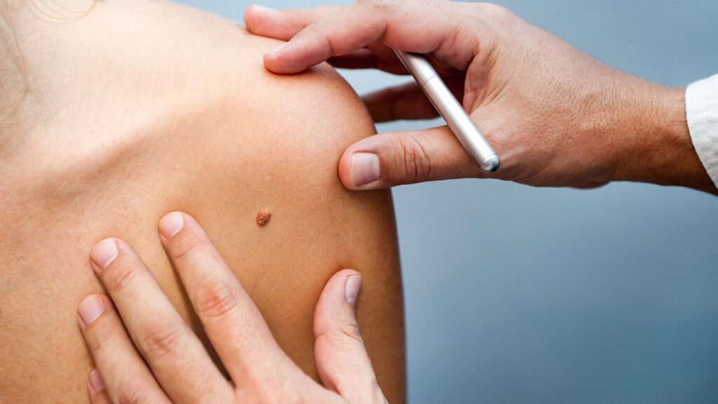 Evaluación de lesiones de la piel para detección de cáncer de piel