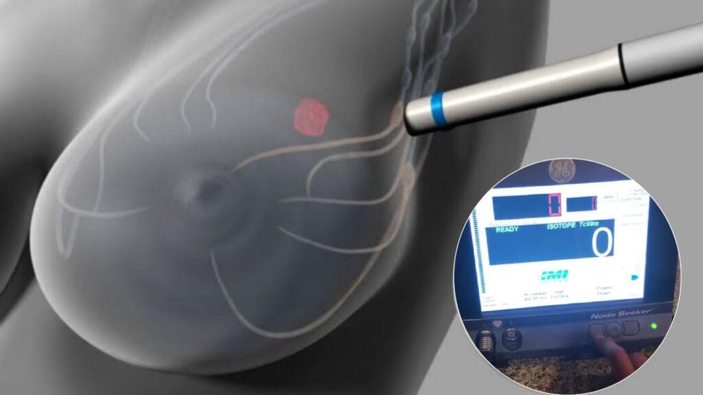 Biopsia de ganglio centinela en cáncer de mama, técnica que evita la disección axilar completa