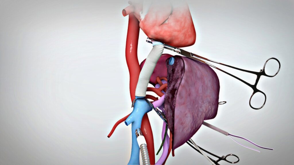 Hepatectomía, cirugía oncológica del hígado
