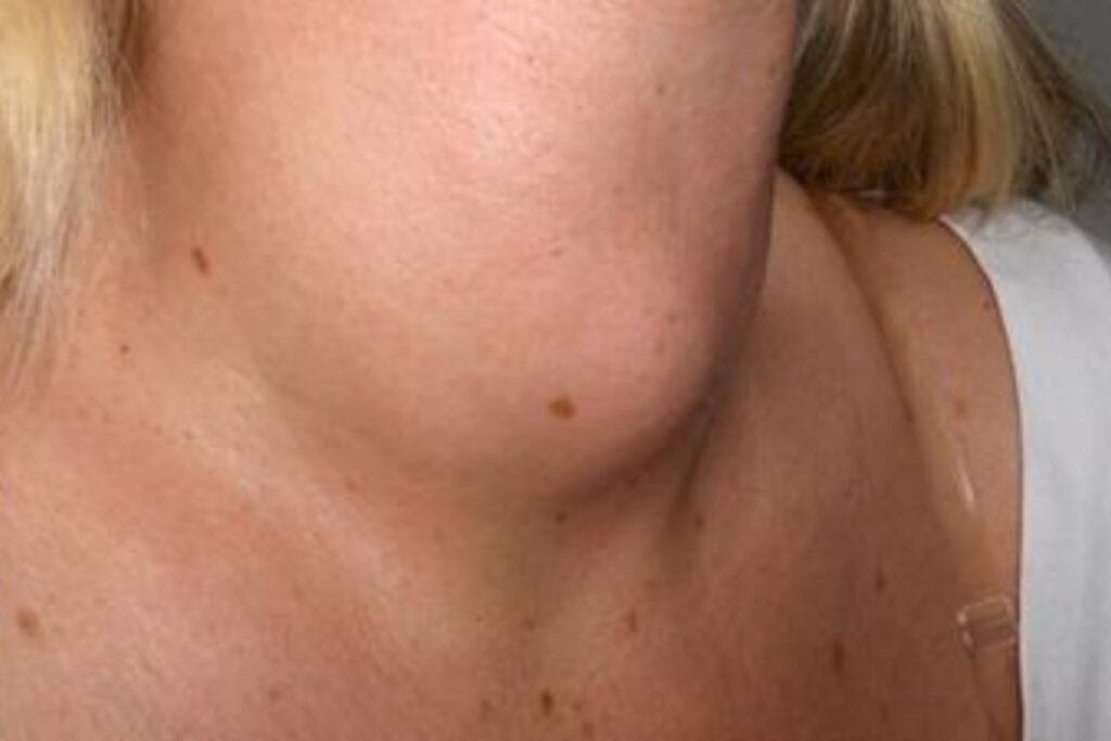 Nódulo tiroideo en valoración con ultrasonido de cuello