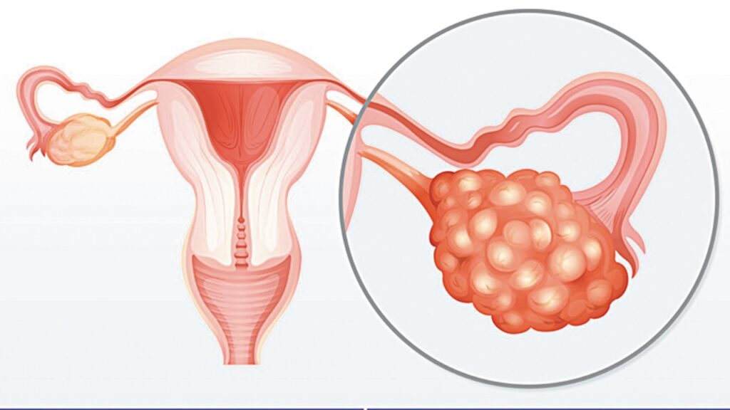 Salud de la mujer y tumores de ovario, valoración con ultrasonido