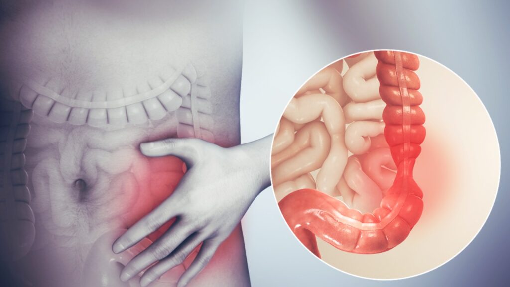 Tumor de colon detectado durante una colonoscopia