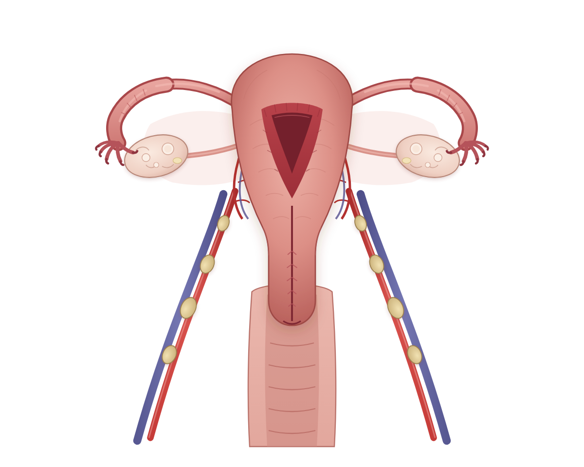 Ilustración del útero con endometrio, miometrio, cuello uterino, trompas, ovarios y ganglios de la pelvis