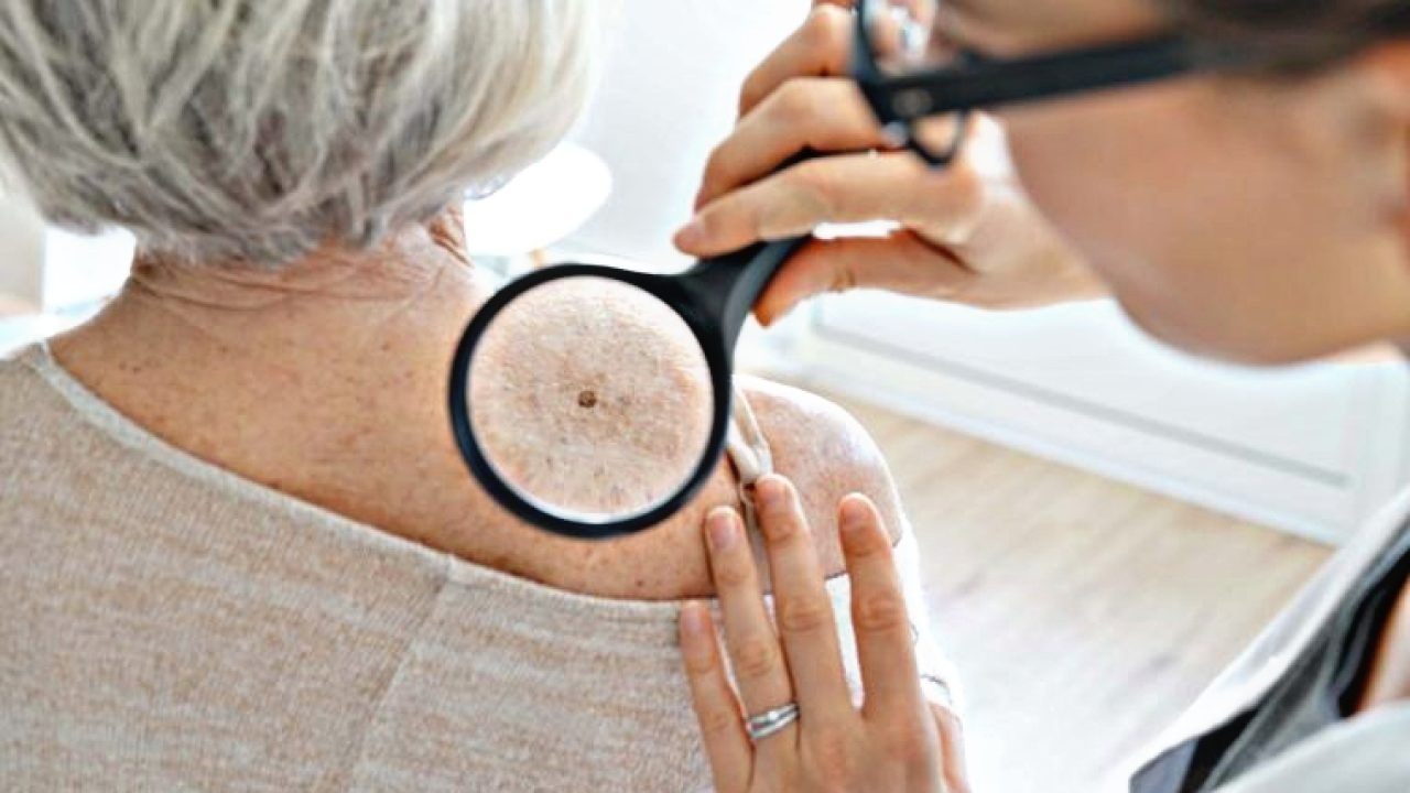 Búsqueda de cáncer de piel Revisión de lunares para detección temprana de melanoma