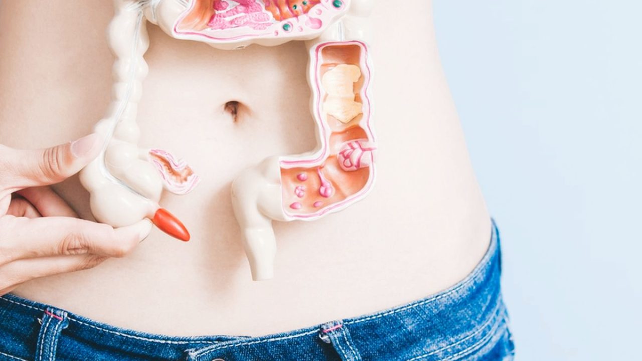 Tratamiento del cáncer de colon Tratamiento quirúrgico del cáncer de colon y recto en Mérida